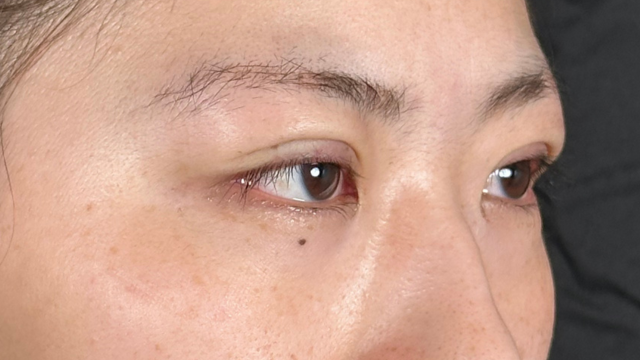 Postoperative Condition Part 1