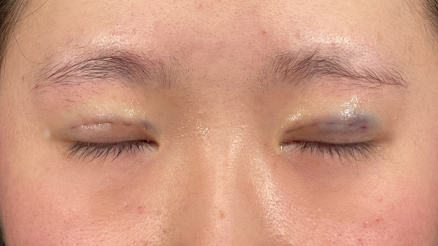 Postoperative Condition Part 1