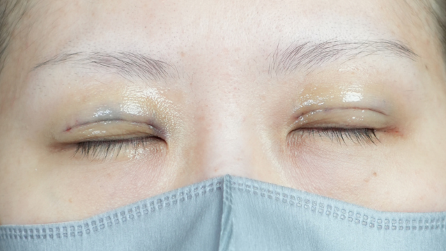 Postoperative Condition Part 1