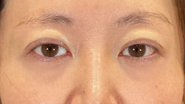 Postoperative Condition Part 1