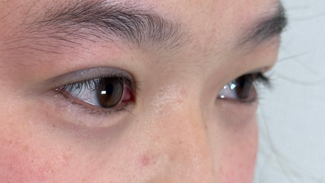 Postoperative Condition Part 1