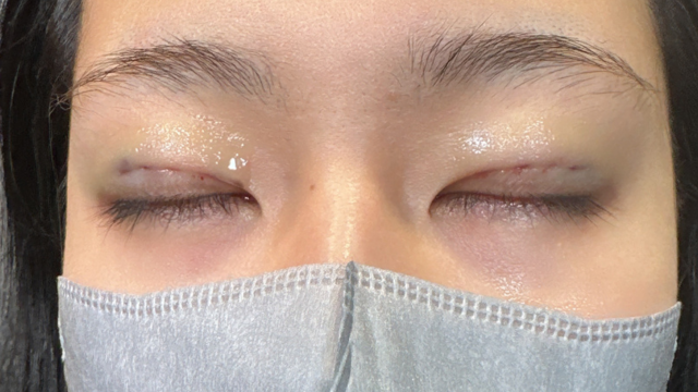 Postoperative Condition Part 1