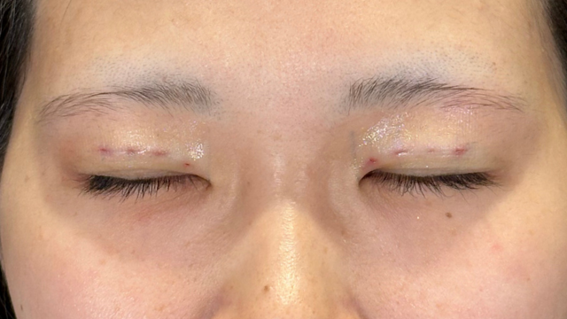 Postoperative Condition Part 1