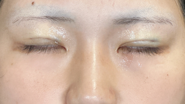 Postoperative Condition Part 1