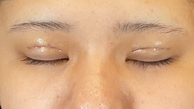 Postoperative Condition Part 1