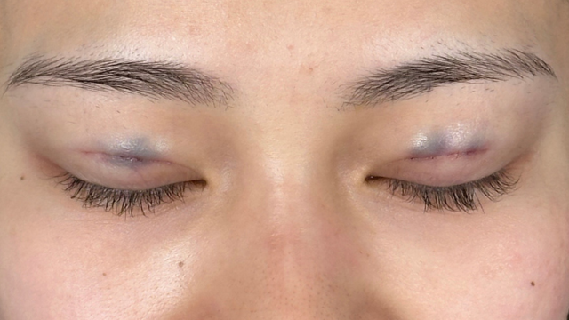 Postoperative Condition Part 1