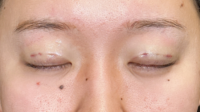 Postoperative Condition Part 1