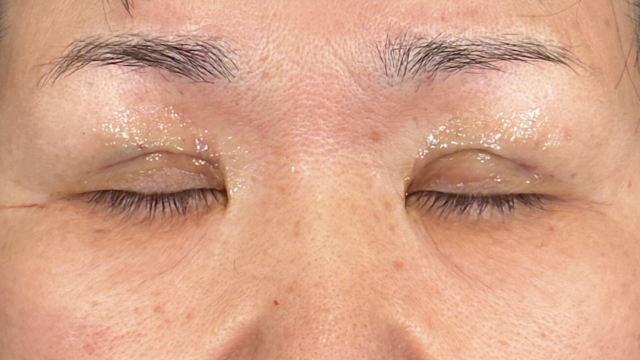 Postoperative Condition Part 1