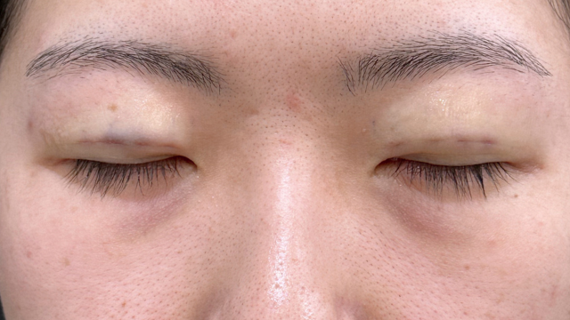 Postoperative Condition Part 1