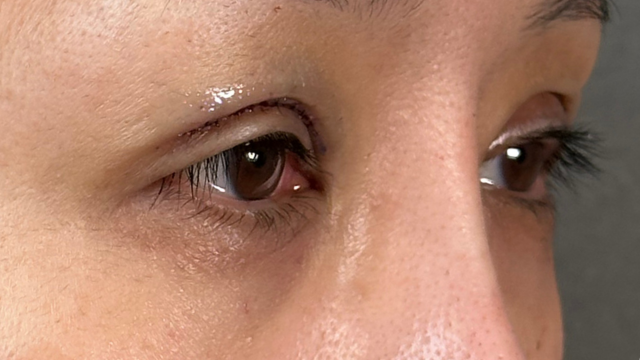 Postoperative Condition Part 1