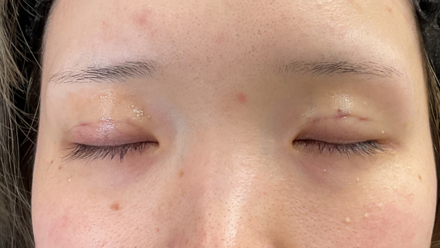 Postoperative Condition Part 1