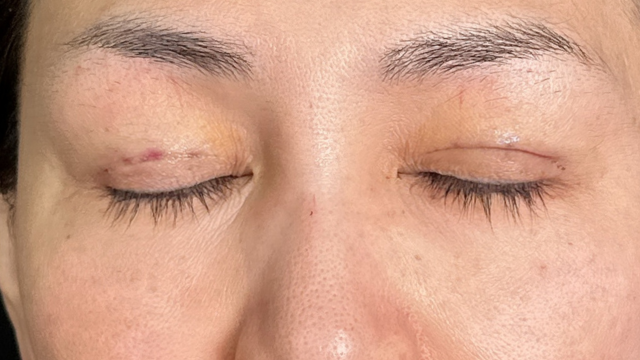 Postoperative Condition Part 1