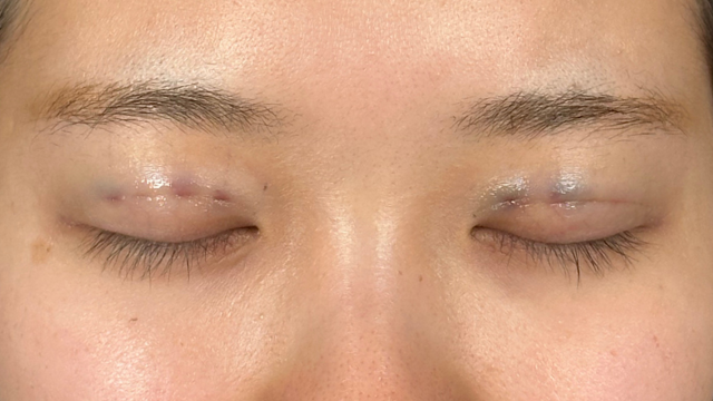 Postoperative Condition Part 1