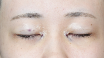 Postoperative Condition Part 1