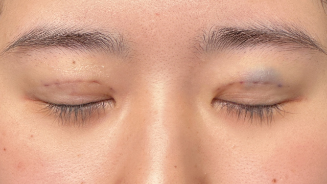 Postoperative Condition Part 1