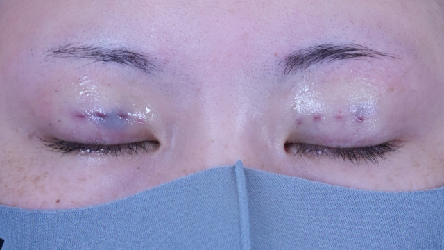 Postoperative Condition Part 1