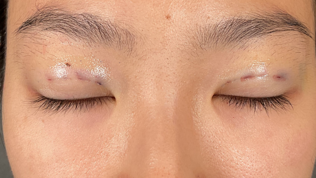 Postoperative Condition Part 1