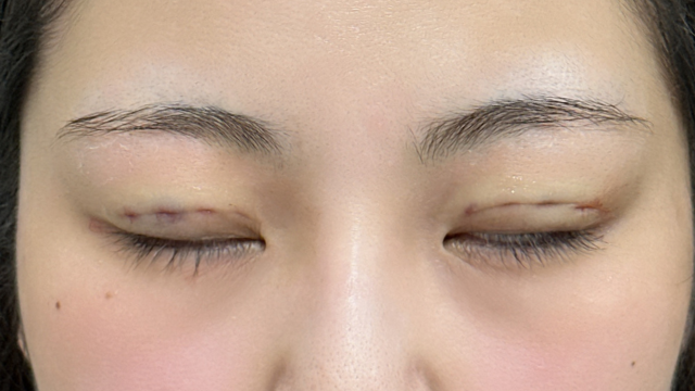 手术前的状态 其一