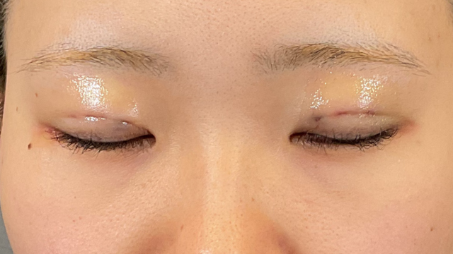 Postoperative Condition Part 1