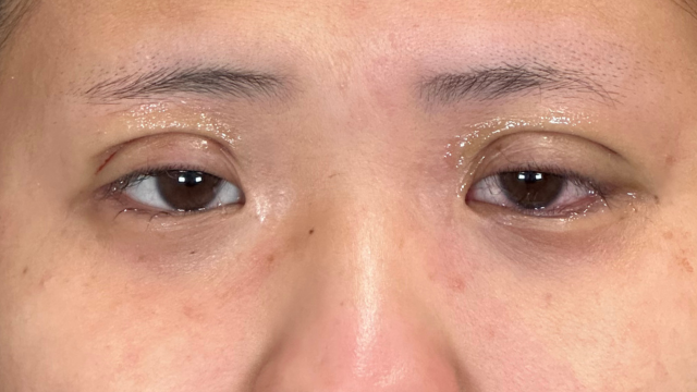 Postoperative Condition Part 1