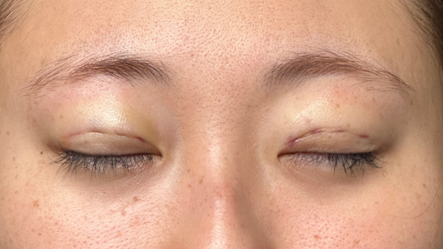 Postoperative Condition Part 1