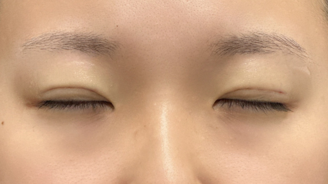 Postoperative Condition Part 1