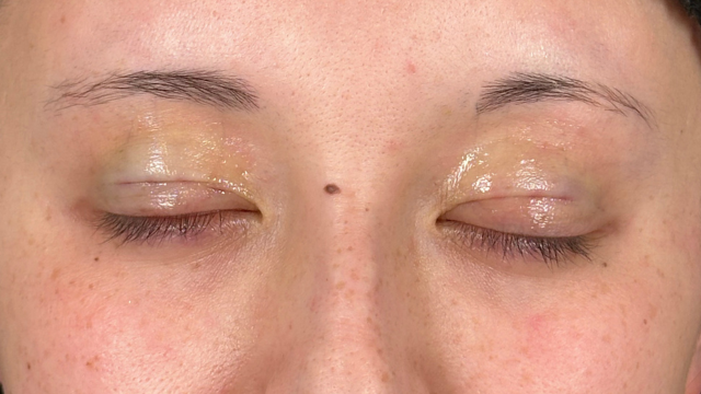 Postoperative Condition Part 1