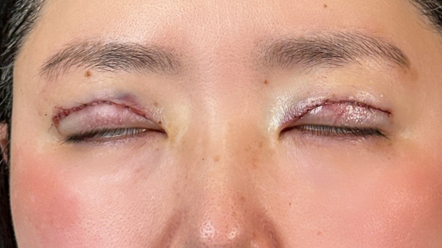 Postoperative Condition Part 1