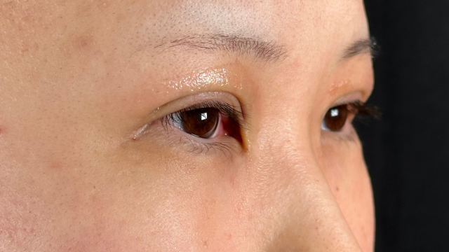 Postoperative Condition Part 1