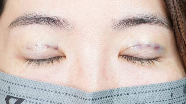 Postoperative Condition Part 1