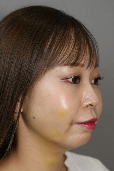 手術前の状態 その1