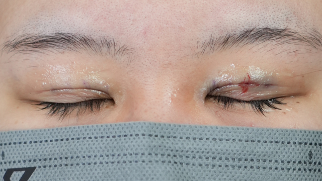 Postoperative Condition Part 1