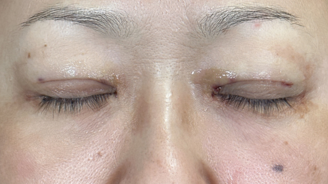 Postoperative Condition Part 1