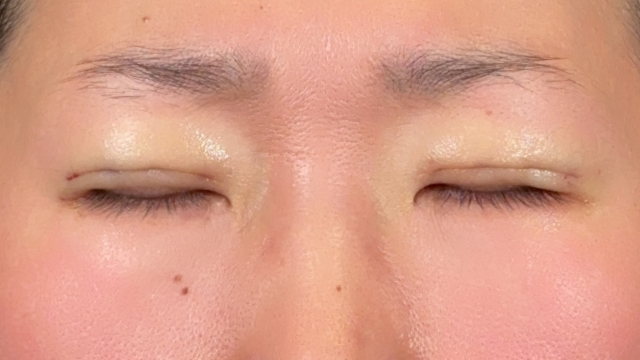 Postoperative Condition Part 1