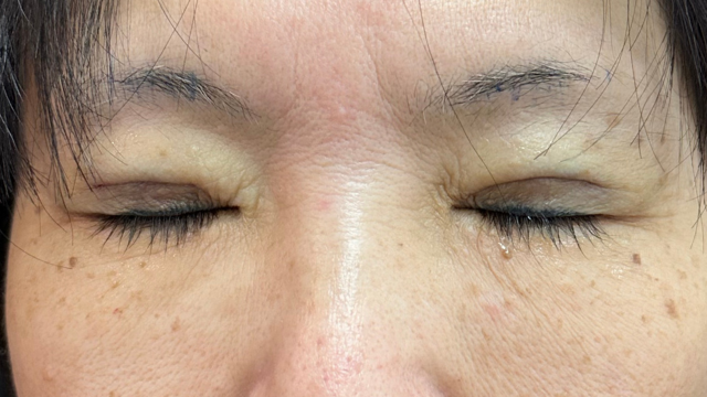 Postoperative Condition Part 1