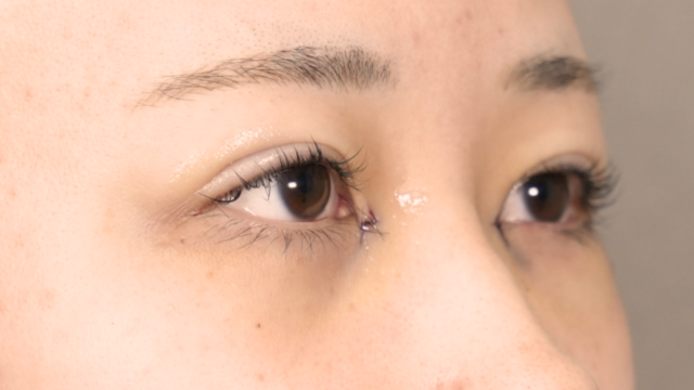 Postoperative Condition Part 1