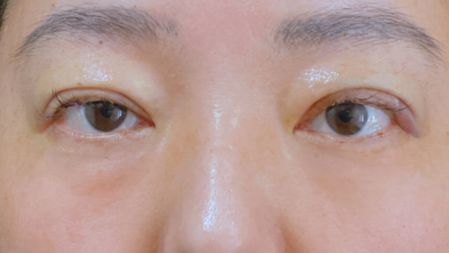 Postoperative Condition Part 1