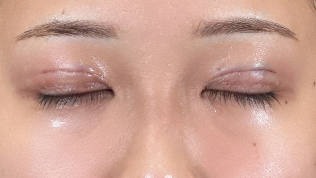 Postoperative Condition Part 1