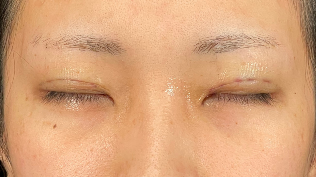 Postoperative Condition Part 1