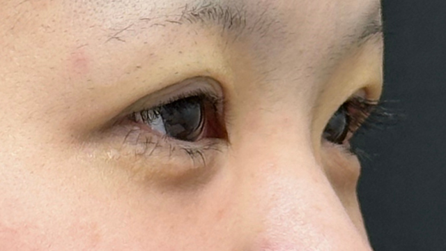 Postoperative Condition Part 1