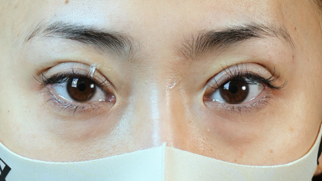 Postoperative Condition Part 1