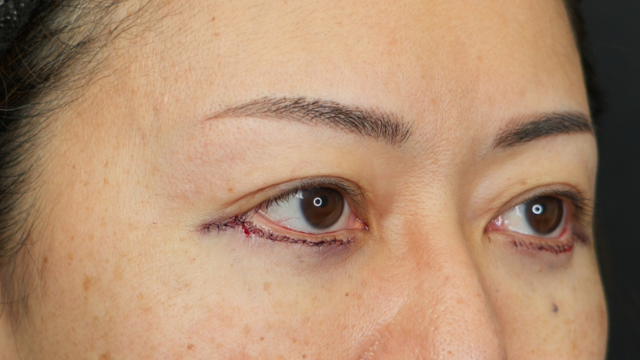 Postoperative Condition Part 1