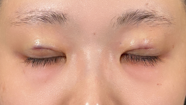 Postoperative Condition Part 1