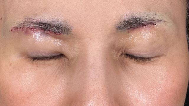 Postoperative Condition Part 1