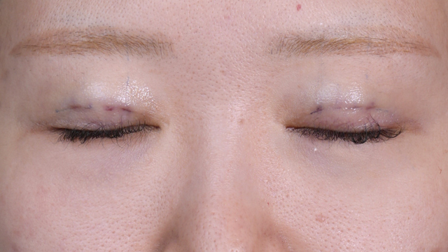 Postoperative Condition Part 1