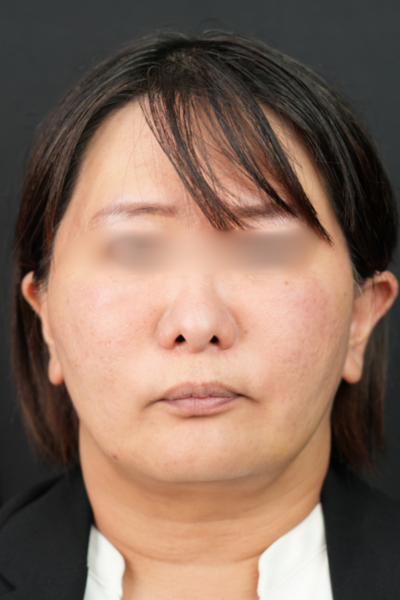 手術前の状態 その1