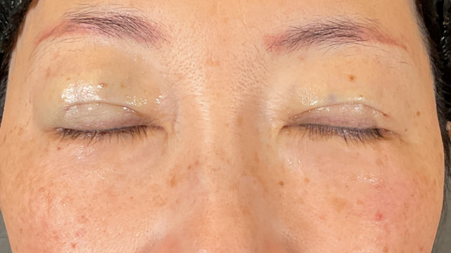 Postoperative Condition Part 1