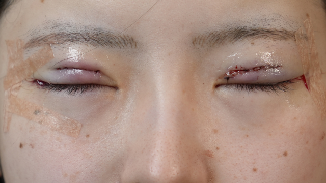 Postoperative Condition Part 1