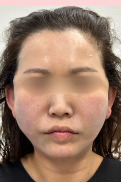 手術前の状態 その1