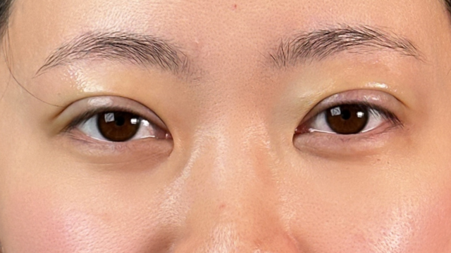 Postoperative Condition Part 1